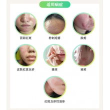 東新豆克速笑復方珍珠暗瘡片中藥84片祛痘濕疹粉刺痤瘡清熱解毒